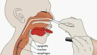 Labor Epidural Placement by TheEpiduralcom [upl. by Marijo]