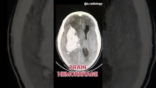 Brain Hemorrhage Radiology shortvideo [upl. by Kurtzig545]