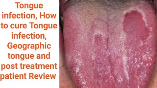 Geographic tongue Tongue infection Mouth inside infection benign migratory glossitis causes amp Tt [upl. by Anaher]