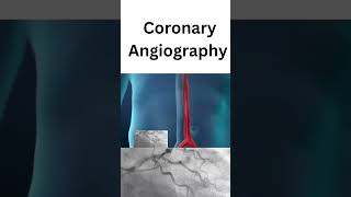 Coronary angiography  treatment of coronary heart disease [upl. by Oretos]