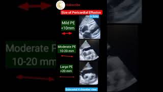 Size of Pericardial effusion in Echo echo ytshortsvideo shortsvideo [upl. by Alakcim]