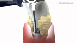 Periimplantitis treatment  animation Dürr Dental [upl. by Laszlo]