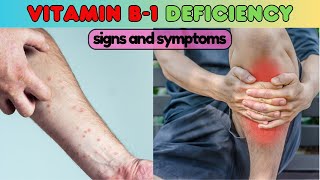 vitamins deficiency symptoms vitamin B1 thiamine deficiency symptoms vitamin b1 deficiency [upl. by Suu736]