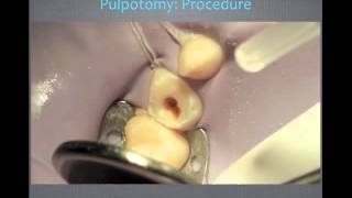 Pulp Therapy and Primary Tooth Pulpotomy  Video Review [upl. by Airotel561]