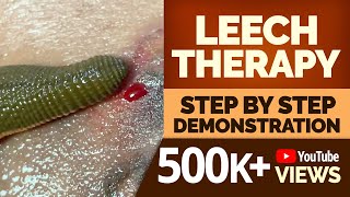 LEECH THERAPY Step by Step Demonstration [upl. by Nilesoy]