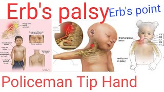 Erbs palsy part  1 Erbs point Erbs duchennepalsy policeman tip hand waiterstiphand [upl. by Ahseenat]