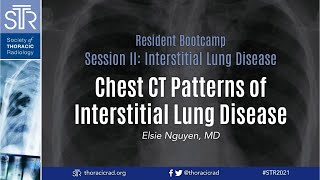 Chest CT Patterns of Interstitial Lung Disease [upl. by Harikahs118]