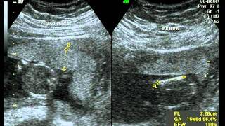 UltraSonografia  16 semanas e 4 dias [upl. by Anaynek]