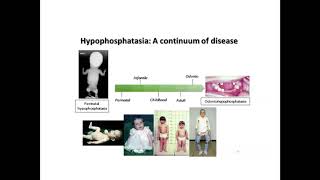 HPP Genetics Boot Camp Learning More About ALPL Gene Changes and HPP in Families 20181029 2300 1 [upl. by Wunder]