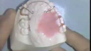 Orthodontic Acrylic Technique [upl. by Taddeusz]