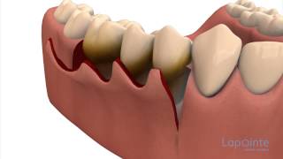 Periodontal flap approach surgery  Lapointe dental centres [upl. by Ellenyl55]