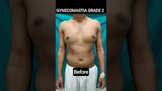 Gynecomastia Surgery liposuction gyno chestfat gynecomastia  glandremoval [upl. by Berne]