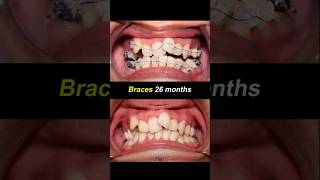 Braces 26 months duration Severely crooked teeth braces orthodontist bracesoff dentist [upl. by Halverson]