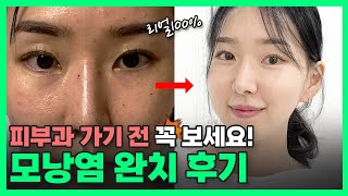 피부과 NO 모낭염 완치 후기 이걸 왜 이제 알았을까😭ㅣ모낭염과 여드름 관리법구분법 모두 공개 [upl. by Allerym]