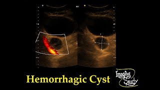 Adnexal Hemorrhagic Cyst  Ultrasound  Case 33 [upl. by Liponis499]