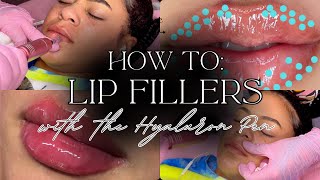 How to do Lip Filler w the Hyaluron Pen  Hyaluron Pen Tutorial  hyaluronpen hyaluronicacid [upl. by Urian307]