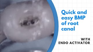 endoactivator  easy bmp in root canal treatment [upl. by Faunie49]