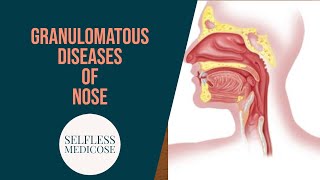 GRANULOMATOUS DISEASES OF NOSE part 3 mucormycosis wegeners granulomatosis in detail [upl. by Lemmy63]