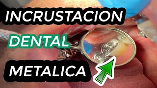 COMO se hacen las INCRUSTACIONES DENTALES METALICAS  Incrustación dental  Restauración de muela 🦷 [upl. by Nil]