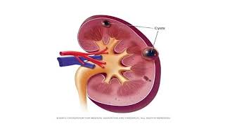 Polycystic Kidney Disease [upl. by Llyrehc]