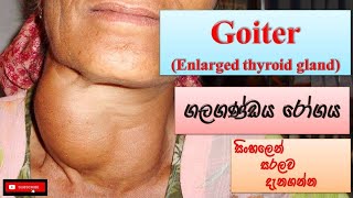 Goiter ගලගණ්ඩය රෝගය how it happens causes symptoms treatments how to prevent [upl. by Herr]