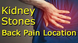 Kidney Stones Back Pain Location [upl. by Aivart]