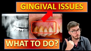 GINGIVITIS treatment vs PERIODONTITIS with TEETH STAINING gingivitis cleaning bleeding [upl. by Reppiks418]