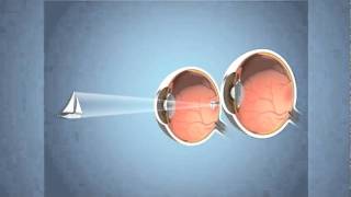 Monovision for Presbyopia [upl. by Lledrac249]