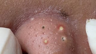 Big Cystic Acne Blackheads Extraction Blackheads amp Milia Whiteheads Removal Pimple Popping  3709 [upl. by Kciredorb]