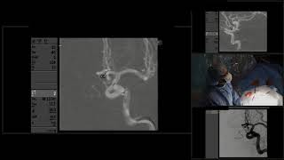 Embolización endovascular de 2 aneurismas con coils [upl. by Inahet]