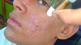 sac be spa blackheads elderly 2025  sac be spa old age blackheads 2025  ASMR sac be spa new 310 [upl. by Debera]