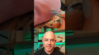 Doctor reacts to fat splinter removal dermreacts doctorreacts splinter splinterremoval [upl. by Esdnil]