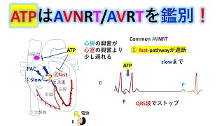 心電図：暗記からの卒業 132話 ATPによる上室性頻拍の鑑別２ [upl. by Ttezzil311]