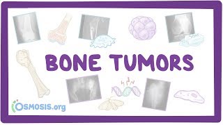 Bone tumors  causes symptoms diagnosis treatment pathology [upl. by Adalai781]