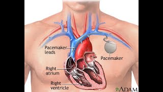 Now powered by Pacemaker  A health update [upl. by Graces]