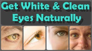 How To Get Clean Eyes Top 10 Methods For Whitening Of Eyes And 10 Foods For Yellow Eyes [upl. by Ferne]