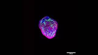 Heart organoids simulate pregestational diabetesinduced congenital heart disease [upl. by Elwira]