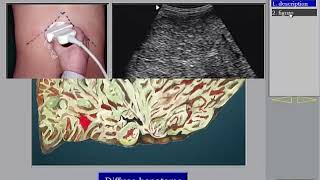 Ultrasound of the Liver HCC 2 in Arabic أورام الكبد [upl. by Nivrag]