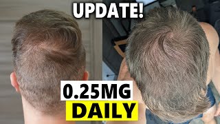 Finasteride Microdosing Update 2022 [upl. by Beuthel]