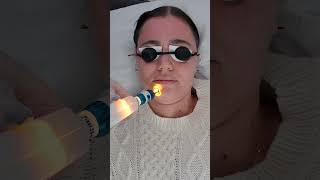 Reveal a new glow with Este Medicals Laser resurfacing facial✨ [upl. by Sweatt334]