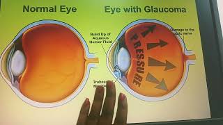 கண் அழுத்த நோய் என்றால் என்ன  What is Eye Pressure tamil  Glaucoma Symptoms tamil [upl. by Ahsenyl644]