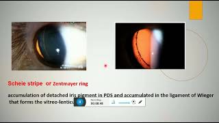 pigment dispersion syndrome and pigmentary glaucoma [upl. by Natrav]