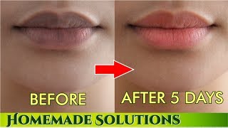 काले होंठो प्राक्रतिक गुलाबी बनाने के नुस्खे  Remove darkness from lips get pink lips [upl. by Bowden460]