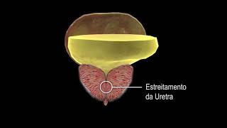 Embolização das Artérias da Próstata [upl. by Naasar]