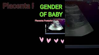 BABY GENDER VS PLACENTA shortsfeedpregnancy [upl. by Ferree]