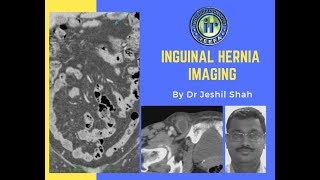 TMT Inguinal Hernia Imaging by Dr Jeshil Shah [upl. by Kcirddes]