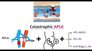 APLA Antiphospholipid Antibody Syndrome amp CAPS Catastrophic APLADr Pradeep Rangappa [upl. by Shanly397]