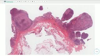 Pigmented Villonodular Synovitis  Joints Histopathology [upl. by Anitnatsnok]