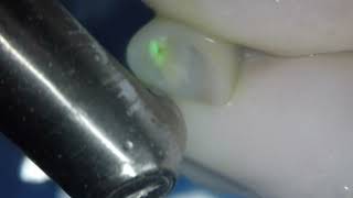 Cement removal from inside Zirconia crown [upl. by Joette]