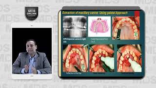 10 Surgical Removal of impacted Canine Causes Indications Contra Indications [upl. by Imac]